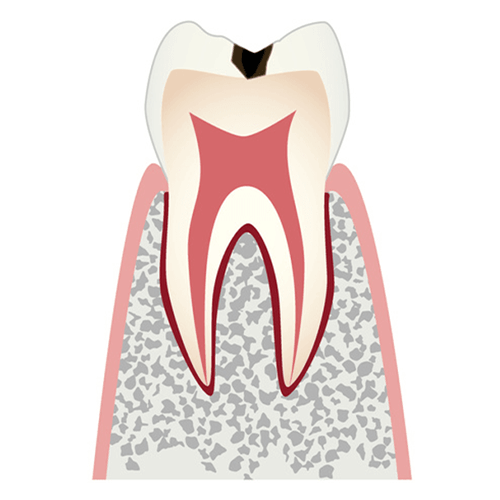 C1 エナメル質に小さな穴が空いたむし歯