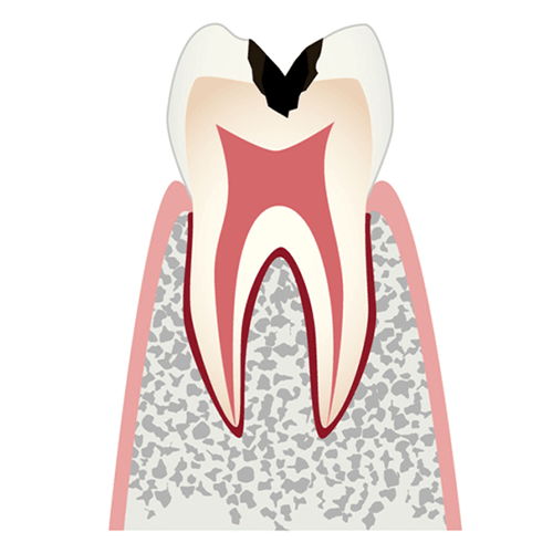 C2 歯の内部(象牙質)まで進行したむし歯