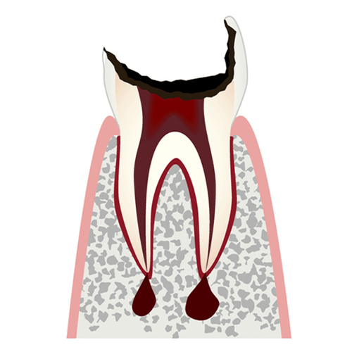 C4 歯根まで進行したむし歯