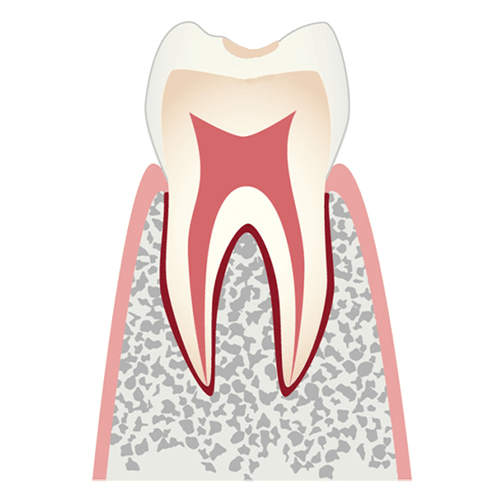CO ごく初期のむし歯