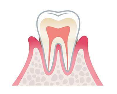 軽度歯周病
