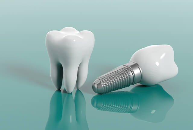 インプラントのイメージ画像