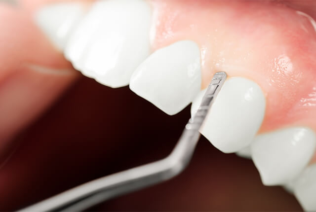 歯周病治療を受けている歯