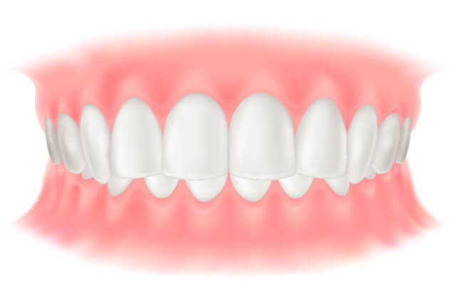 過蓋咬合(かがいこうごう)